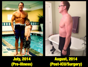 Figure 4 - Lean Body Mass Loss Over 20 days following surgery and critical illness (20 kg over 20 days = 1 kg lean body mass lost/day).